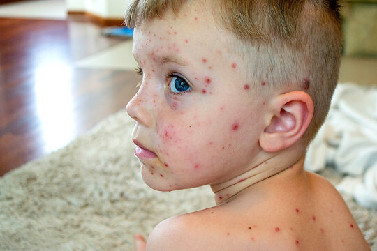 CHICKENPOX 