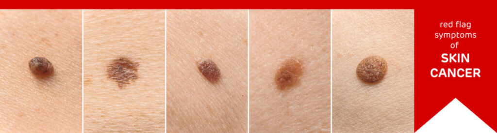 skin cancer