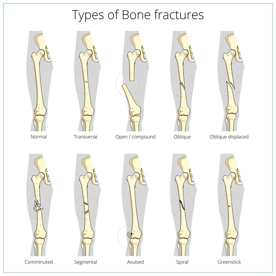 TYPES OF BONE FRACTURES