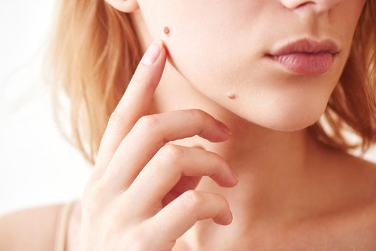 mole on face